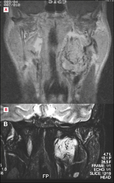 Microsurgery in primary tumours of the parapharyngeal space: observational retrospective analysis of a series of consecutive cases.