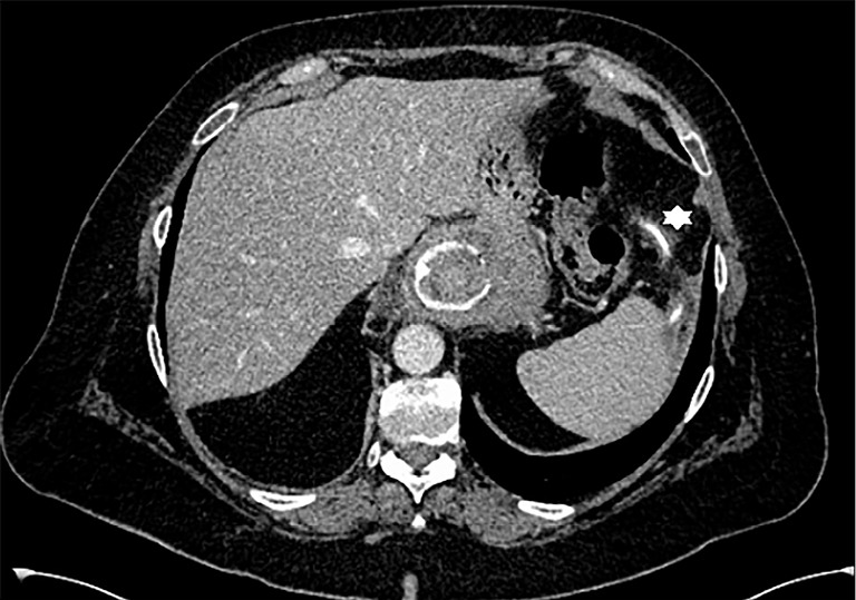 Gastric banding adjustment catheter dislodgement and perforation into the colon: case report.