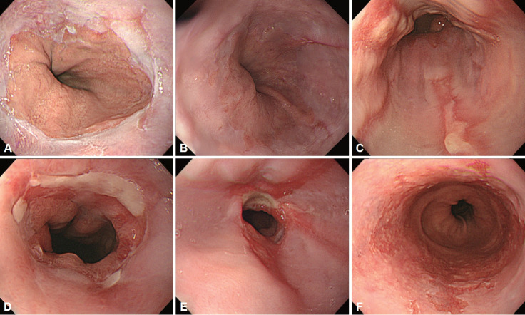 Reflux Esophagitis.
