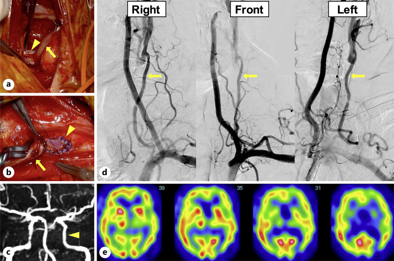 Subclavian Artery-Internal Carotid Artery Bypass Using a Radial Artery Graft for Common Carotid Artery Occlusion with Immediate Improvement of Cognitive Function: A Case Report.