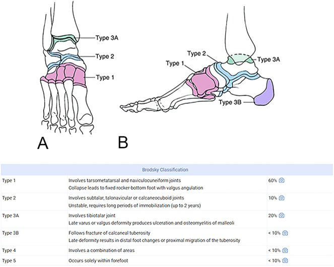 Management of hindfoot and ankle in Charcot arthropathy.