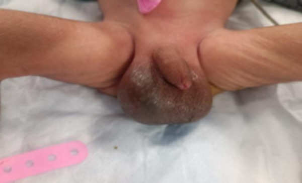 Neonatal Adrenal Haemorrhage Mimicking Acute Scrotum: A Case Report.