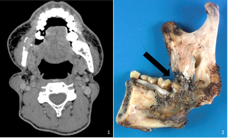 Radiation-Induced Intraosseous Malignant Peripheral Nerve Sheath Tumor: A Case Report.