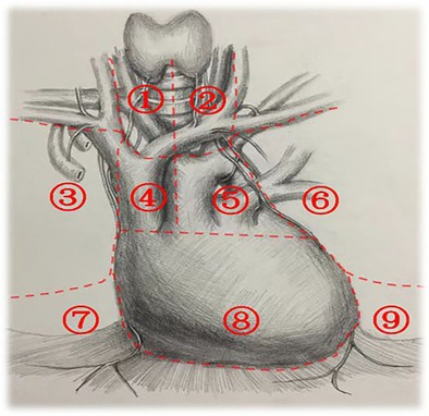 Expert Consensus on Subxiphoid and Subcostal Arch Thoracoscopic Resection for the Treatment of Thymoma.