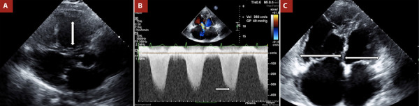 The role of agitated saline contrast echocardiography in the evaluation of pulmonary hypertension.
