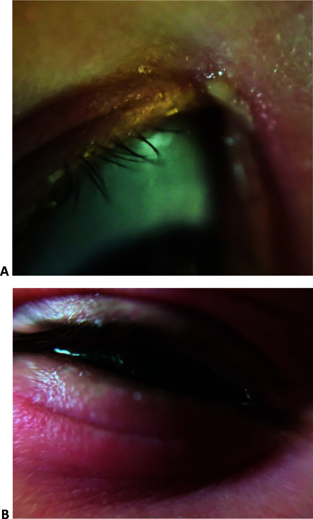 Conservative management of paediatric dacryocystitis: a collection of clinical experiences highlighting effectiveness and parental satisfaction.