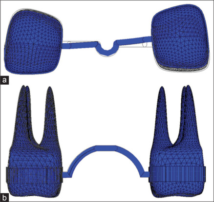 Finite element analysis of the transpalatal arch force systems activated in the Burstone geometries with different materials.