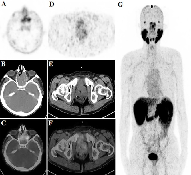 <sup>68</sup>Ga-PSMA-Avid Sinonasal Intestinal-Type Adenocarcinoma.
