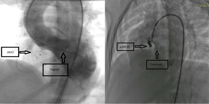 Short and Mid-term Outcomes of Percutaneous Perimembranous Ventricular Septal Defect Closure Using Amplatzer Duct Occluders Type II in Children and Adolescents.
