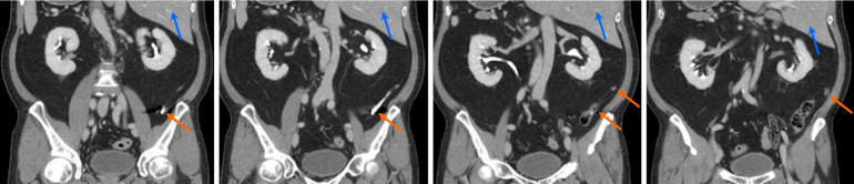 Retrospective analysis of computed tomography examinations in patients with lower abdominal pain: A single-center experience.