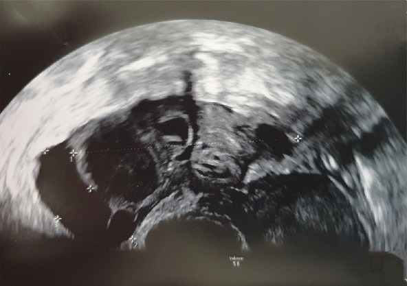 Recurrent Pelvic Inflammatory Disease After Serial Intrauterine Inseminations.