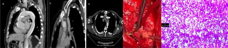 <i>Candida albicans</i> Aortic Fungus Ball in a Behçet's Disease Patient.