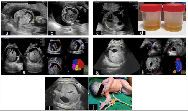 Tiny Lungs, Big Challenges: Navigating Fetal Pleural Effusion Outcomes, Long Term Follow-up and Implications for Future Pregnancies.