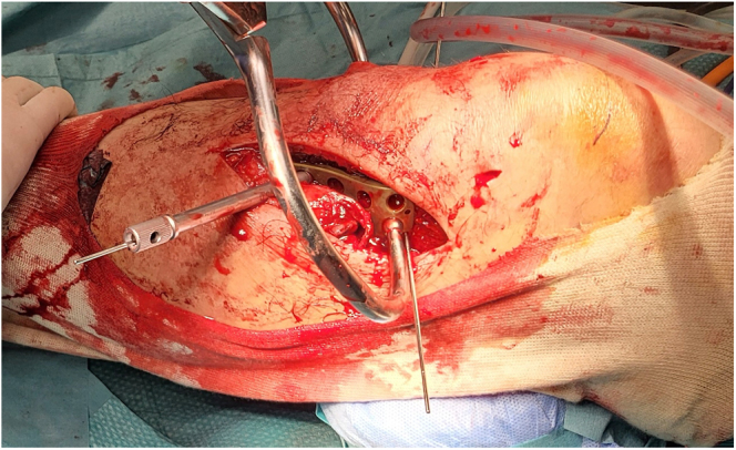 Posterolateral tibia plateau fractures: pros and cons of different surgical approaches.