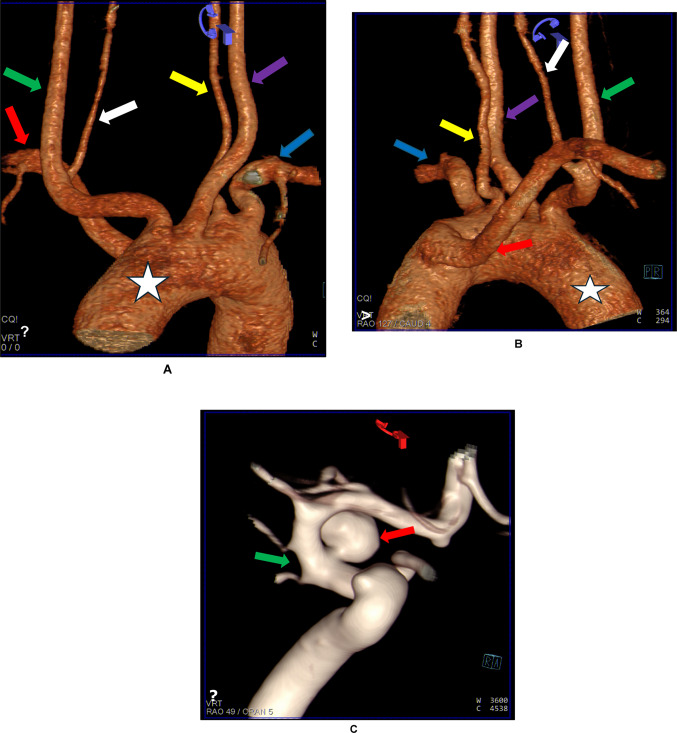 A rare variation of five major vessels arising from the aortic arch with an absence of brachiocephalic trunk.
