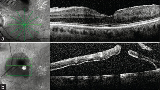 Resolution of the hole-related subclinical retinal detachment following barrage and sectorial laser photocoagulation in ischemic branch retinal vein occlusion.