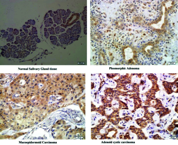 Immunohistochemical Expression of Baculoviral Inhibitor of Apoptotic Proteins Repeat-Containing Protein in Tumors of Salivary Gland Origin.