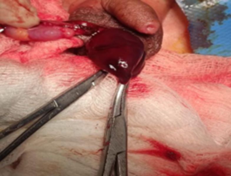 Neonatal Adrenal Haemorrhage Mimicking Acute Scrotum: A Case Report.