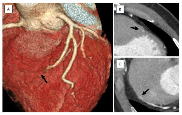 Unmasking Myocardial Bridging: Multimodal Imaging and Tailored Medical Approach in Exercise-induced Angina - A Case Report.