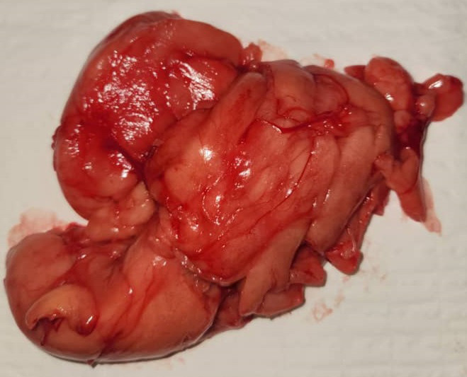 [Giant laterocervical lipoma in a 6-month-old infant: a case report].
