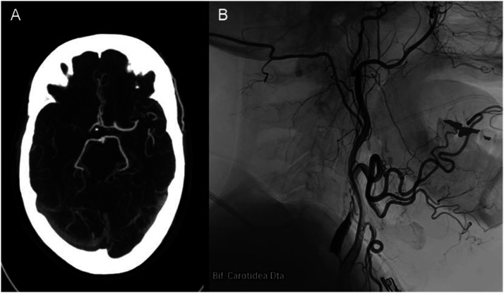 Internal carotid artery rupture during endovascular thrombectomy in patients with tandem occlusion: A two-case report.
