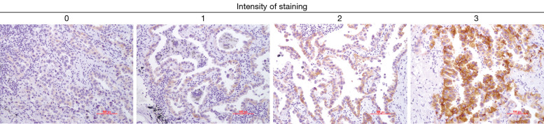 Impact of mutant protein expression on clinical outcomes in patients with EGFR L858R-mutated non-small cell lung cancer.