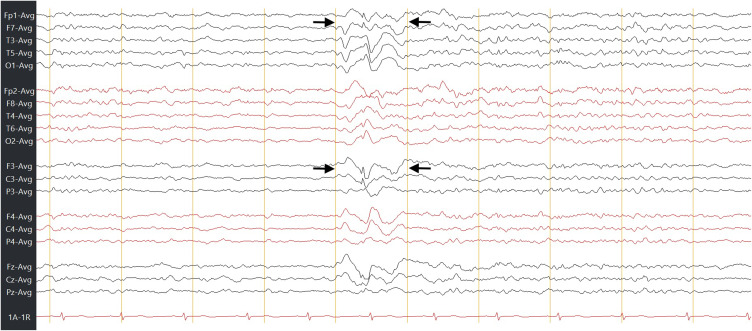 Recurrent Cerebrospinal Fluid Rhinorrhea Secondary to a Seizure-Induced Skull-Base Defect: An Unusual Complication of Epilepsy.
