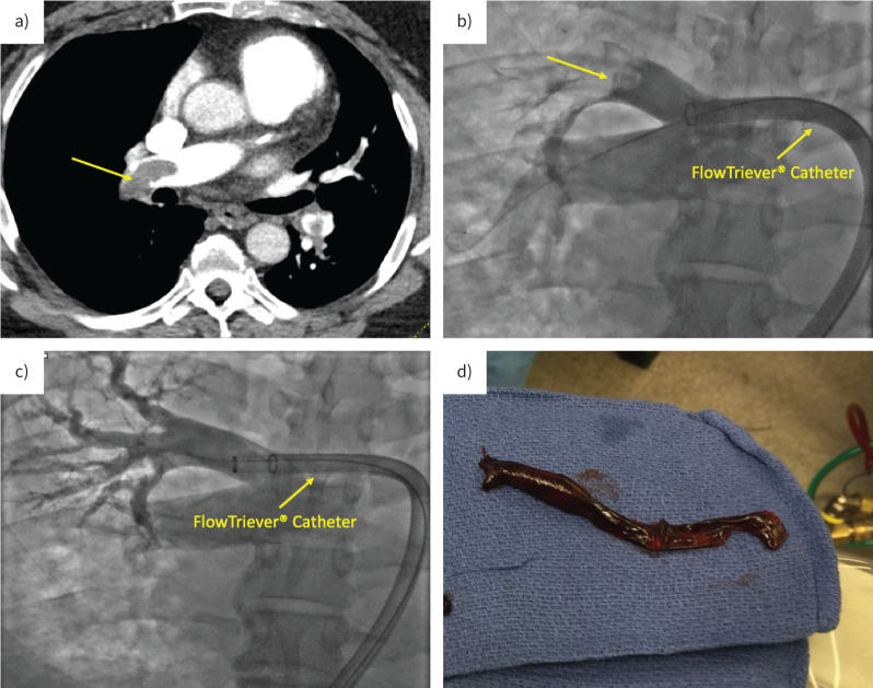 The latest in the management of pulmonary embolism.