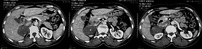 Adrenal Incidentaloma Masquerading as Malignancy: A Rare Case of Ganglioneuroma with Nodal Metastasis.