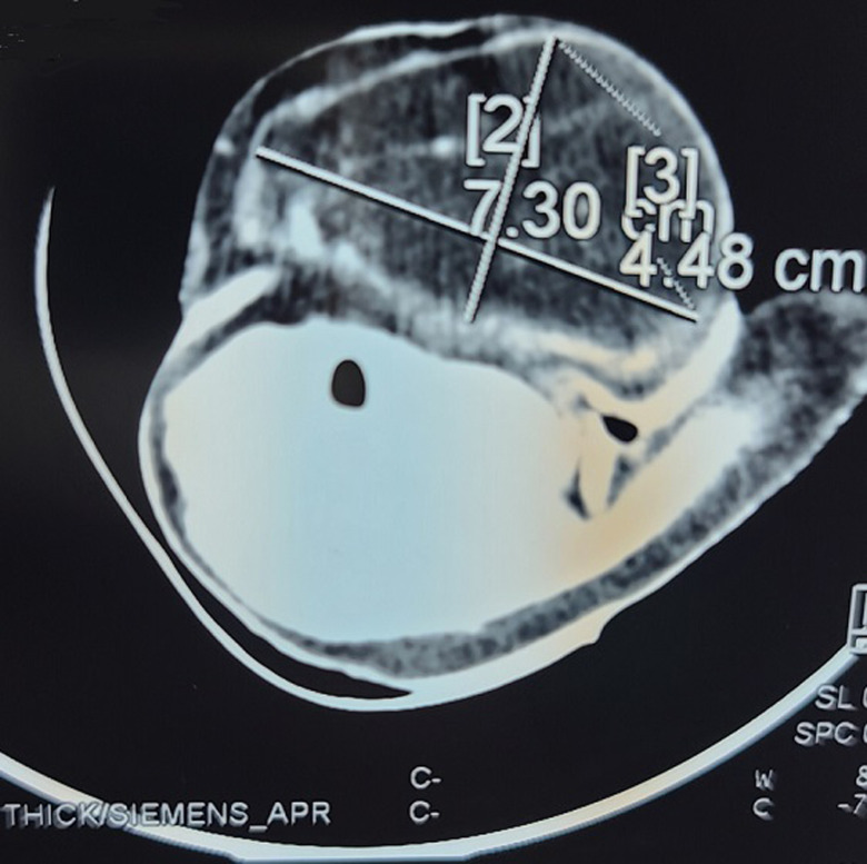 [Giant laterocervical lipoma in a 6-month-old infant: a case report].