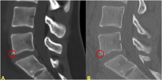 Magnetic Resonance Imaging-Generated Synthetic Computed Tomography in Pediatric Spine Patients.