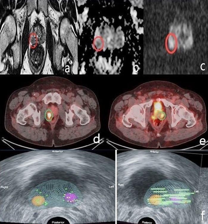 Combined <sup>68</sup>Ga-PSMA PET/CT and mpMRI Findings Improve Tumor Localization and Biopsy Guidance in the Initial Diagnosis of Prostate Cancer.