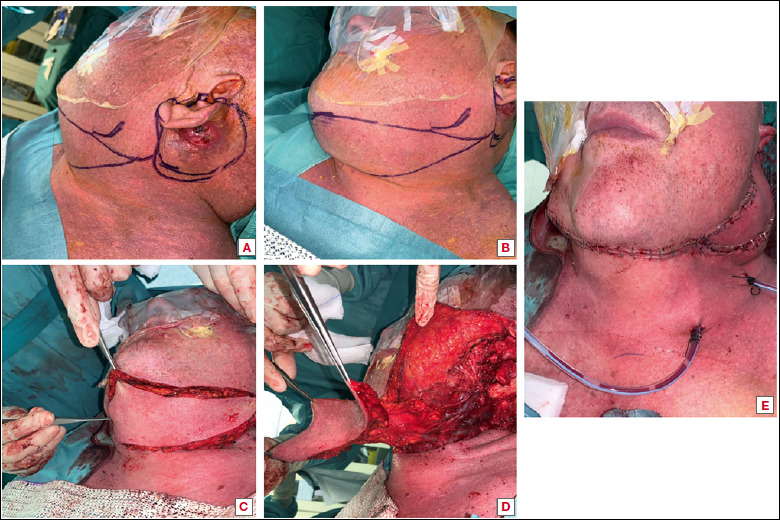 Exploring the use of submental flap for parotid region reconstruction: a multicentric experience.