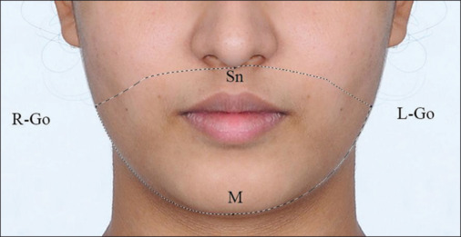 Chin asymmetry perception among orthodontists, general dentists, and laypersons.
