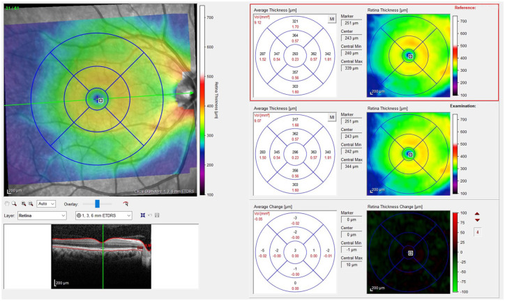 Evaluating the impact of anti-CGRP monoclonal antibodies on retinal features in migraine patients: a retrospective optical coherence tomography study.