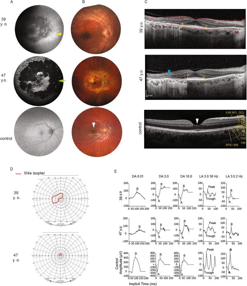 Defective IFT57 underlies a novel cause of Bardet-Biedl syndrome.