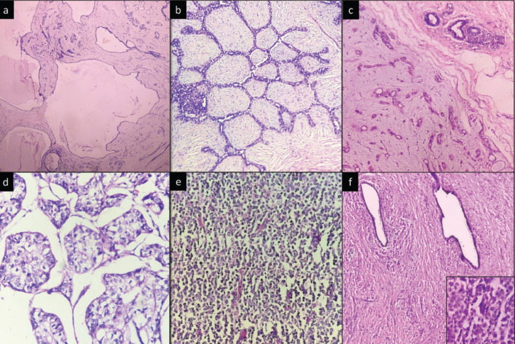 Categorization of Breast Fine Needle Aspirates Using Yokohama Classification and Its Correlation With Histopathological Findings.