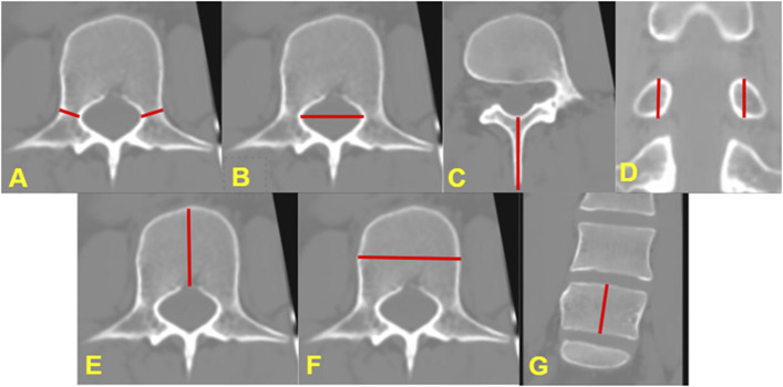 Magnetic Resonance Imaging-Generated Synthetic Computed Tomography in Pediatric Spine Patients.
