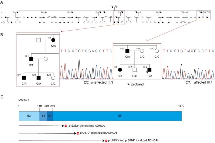 Identifying a Novel Causal FAM83H Variant for Autosomal Dominant Amelogenesis Imperfecta Using Exome-Sequencing.