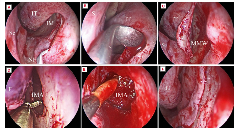 Ostiomeatal complex preservation: submucosal inferior meatal antrostomy for maxillary sinus pathologies.