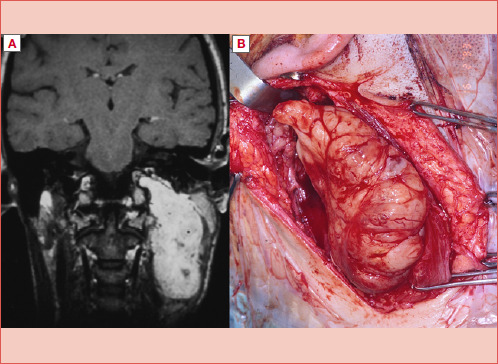 Microsurgery in primary tumours of the parapharyngeal space: observational retrospective analysis of a series of consecutive cases.