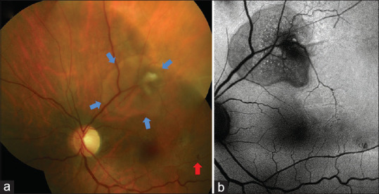 Resolution of the hole-related subclinical retinal detachment following barrage and sectorial laser photocoagulation in ischemic branch retinal vein occlusion.
