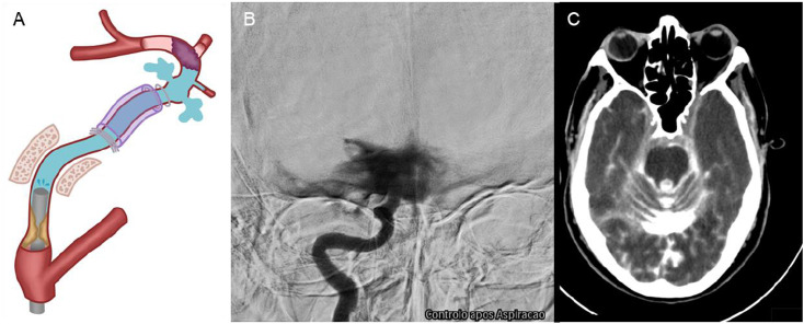 Internal carotid artery rupture during endovascular thrombectomy in patients with tandem occlusion: A two-case report.