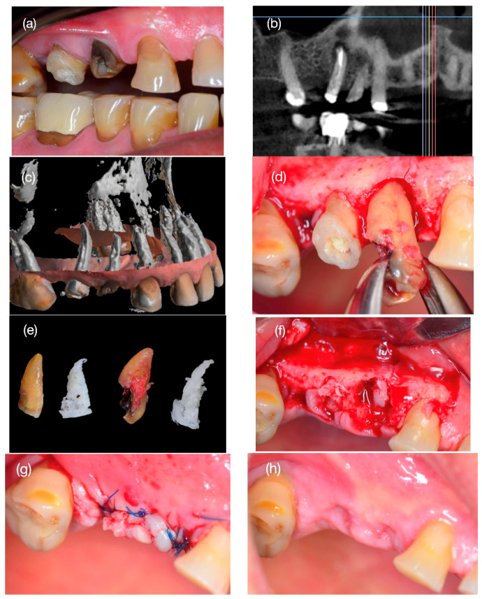 Alveolar Ridge Preservation Using Three-Dimensional Root Replicas of Polycaprolactone: A Radiological and Histological Evaluation of a Case Report.