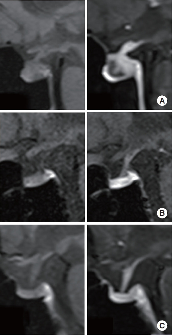 Combined PD-1 and CTLA-4 Blockade Increases the Risks of Multiple Pituitary Hormone Deficiency and Isolated Adrenocorticotropic Deficiency: A Prospective Study.