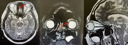When patients present with bulging eyes: A case series of proptosis.