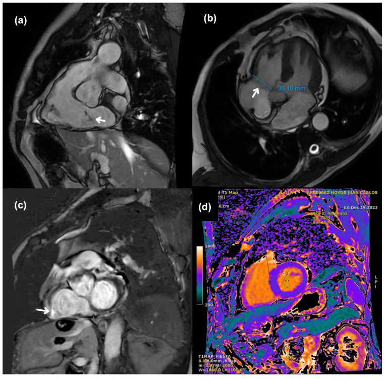 Tricuspid Regurgitation Following Cavotricuspid Isthmus Ablation: A Case Report.