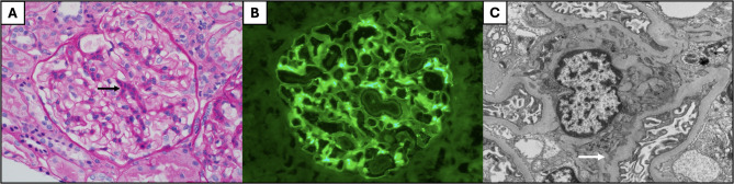 Two unique cases of eosinophilic granulomatosis with polyangiitis in childhood treated with anti-interleukin-5 therapy: infantile-onset and submandibular salivary gland involvement.