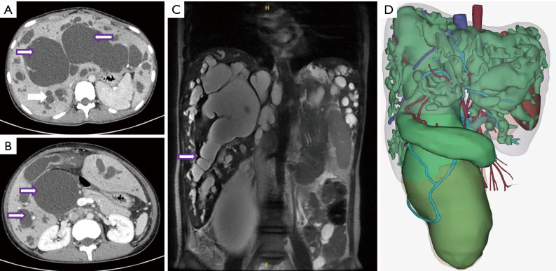 Type IVa bile duct dilatation in an adult female treated with living donor liver transplantation.