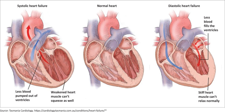 An approach to heart failure for the public-sector primary care clinician.